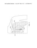 SUBSTERNAL PLACEMENT OF A PACING AND/OR DEFIBRILLATING ELECTRODE diagram and image