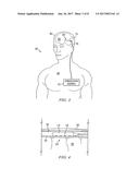 Electrical Stimulation System and Method for Stimulating Tissue in the     Brain to Treat a Neurological Condition diagram and image