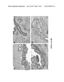 MICRORNA ASSAY FOR DETECTION AND MANAGEMENT OF PANCREATIC CANCER     PRECURSORS diagram and image