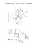 Torque Alleviating Intra-Airway Lung Volume Reduction Compressive Implant     Structures diagram and image