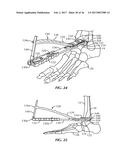 SURGICAL INSTRUMENTATION AND METHODS OF USE FOR IMPLANTING A PROSTHESIS diagram and image