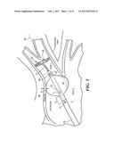 REAL-TIME LESION FORMATION ASSESSMENT diagram and image