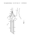 ABLATION CATHETER diagram and image