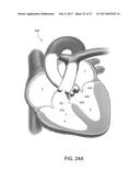HEART OCCLUSION DEVICES diagram and image