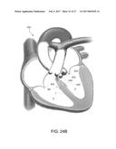 HEART OCCLUSION DEVICES diagram and image