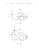 MINIMALLY INVASIVE SPINAL FUSION SYSTEM AND METHOD diagram and image