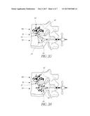 MINIMALLY INVASIVE SPINAL FUSION SYSTEM AND METHOD diagram and image