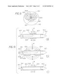 Method for Treating a Tubular Anatomical Structure diagram and image