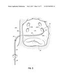 SYSTEMS, DEVICES AND METHODS FOR TREATING THE HEART WITH ABLATION diagram and image