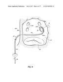 SYSTEMS, DEVICES AND METHODS FOR TREATING THE HEART WITH ABLATION diagram and image