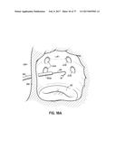 SYSTEMS, DEVICES AND METHODS FOR TREATING THE HEART WITH ABLATION diagram and image