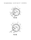 SYSTEMS, DEVICES AND METHODS FOR TREATING THE HEART WITH ABLATION diagram and image