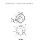 SYSTEMS, DEVICES AND METHODS FOR TREATING THE HEART WITH ABLATION diagram and image