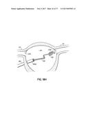 SYSTEMS, DEVICES AND METHODS FOR TREATING THE HEART WITH ABLATION diagram and image