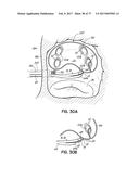 SYSTEMS, DEVICES AND METHODS FOR TREATING THE HEART WITH ABLATION diagram and image