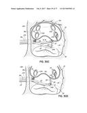 SYSTEMS, DEVICES AND METHODS FOR TREATING THE HEART WITH ABLATION diagram and image