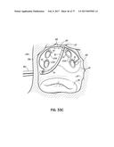 SYSTEMS, DEVICES AND METHODS FOR TREATING THE HEART WITH ABLATION diagram and image