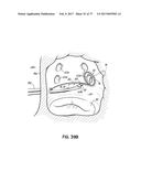 SYSTEMS, DEVICES AND METHODS FOR TREATING THE HEART WITH ABLATION diagram and image