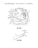 SYSTEMS, DEVICES AND METHODS FOR TREATING THE HEART WITH ABLATION diagram and image