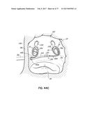 SYSTEMS, DEVICES AND METHODS FOR TREATING THE HEART WITH ABLATION diagram and image