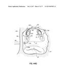 SYSTEMS, DEVICES AND METHODS FOR TREATING THE HEART WITH ABLATION diagram and image