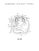 SYSTEMS, DEVICES AND METHODS FOR TREATING THE HEART WITH ABLATION diagram and image