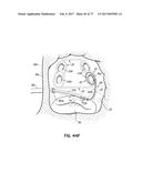 SYSTEMS, DEVICES AND METHODS FOR TREATING THE HEART WITH ABLATION diagram and image