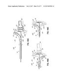 SYSTEMS, DEVICES AND METHODS FOR TREATING THE HEART WITH ABLATION diagram and image