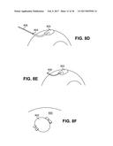 SCLERAL PROSTHESIS FOR TREATING PRESBYOPIA AND OTHER EYE DISORDERS AND     RELATED DEVICES AND METHODS diagram and image