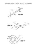 SCLERAL PROSTHESIS FOR TREATING PRESBYOPIA AND OTHER EYE DISORDERS AND     RELATED DEVICES AND METHODS diagram and image