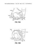 SCLERAL PROSTHESIS FOR TREATING PRESBYOPIA AND OTHER EYE DISORDERS AND     RELATED DEVICES AND METHODS diagram and image