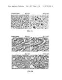 G-Alpha Interacting Vesicle Associated Protein (GIV) as a Predictive     Marker in Stage II Colorectal Cancer diagram and image