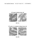 G-Alpha Interacting Vesicle Associated Protein (GIV) as a Predictive     Marker in Stage II Colorectal Cancer diagram and image