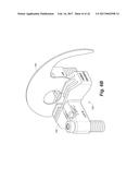 BONE POSITIONING AND PREPARING GUIDE SYSTEMS AND METHODS diagram and image