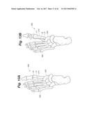 BONE POSITIONING AND PREPARING GUIDE SYSTEMS AND METHODS diagram and image