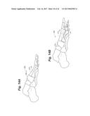 BONE POSITIONING AND PREPARING GUIDE SYSTEMS AND METHODS diagram and image