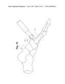 BONE POSITIONING AND PREPARING GUIDE SYSTEMS AND METHODS diagram and image