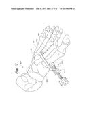 BONE POSITIONING AND PREPARING GUIDE SYSTEMS AND METHODS diagram and image