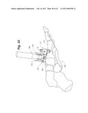 BONE POSITIONING AND PREPARING GUIDE SYSTEMS AND METHODS diagram and image