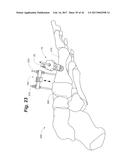 BONE POSITIONING AND PREPARING GUIDE SYSTEMS AND METHODS diagram and image