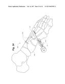 BONE POSITIONING AND PREPARING GUIDE SYSTEMS AND METHODS diagram and image