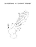 BONE POSITIONING AND PREPARING GUIDE SYSTEMS AND METHODS diagram and image