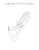 BONE POSITIONING AND PREPARING GUIDE SYSTEMS AND METHODS diagram and image