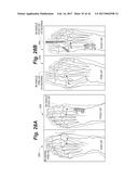 BONE POSITIONING AND PREPARING GUIDE SYSTEMS AND METHODS diagram and image