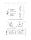 BONE POSITIONING AND PREPARING GUIDE SYSTEMS AND METHODS diagram and image