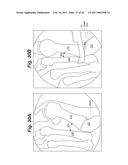 BONE POSITIONING AND PREPARING GUIDE SYSTEMS AND METHODS diagram and image