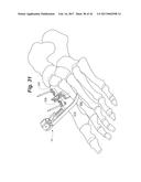 BONE POSITIONING AND PREPARING GUIDE SYSTEMS AND METHODS diagram and image