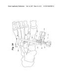 BONE POSITIONING AND PREPARING GUIDE SYSTEMS AND METHODS diagram and image