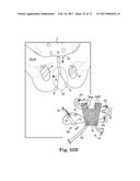 TISSUE ANCHOR AND A SUTURE INSERTED THROUGH THE TISSUE ANCHOR HAVING END     PORTIONS OF THE SUTURE MAINTAINED WITHIN A CONDUIT diagram and image