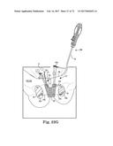 TISSUE ANCHOR AND A SUTURE INSERTED THROUGH THE TISSUE ANCHOR HAVING END     PORTIONS OF THE SUTURE MAINTAINED WITHIN A CONDUIT diagram and image